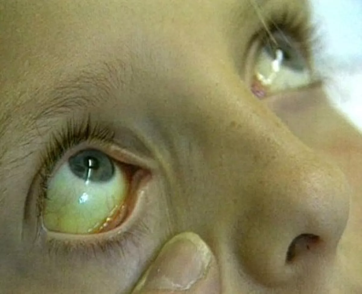 Почему глаза желтоватого. Иктеричность кожных склер. Синдром Жильбера 7. Синдром Жильбера пожелтение склер.